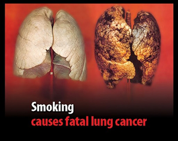 Lung cancer